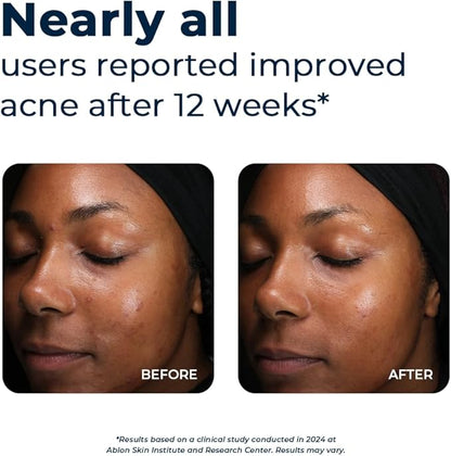 VitaMedica Clear Skin Vitamin Formula | Acne Supplement for Skin Clearing | Breakout Treatment for Women and Men | Vitamins A, C, E, Selenium, Chromium, and Zinc for Acne and Skin Health | 60 Count