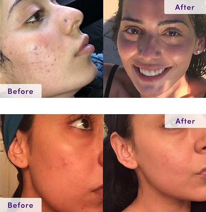 NxN Acne Treatment Kit 4-Step Clear Skin System with Salicylic Acid, Probiotics, Sulfer & Natural Retinols, Control Blemishes & Breakouts, Face Care Solution Set for All Skin Types Including Sensitive