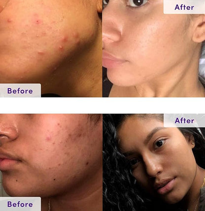 NxN Acne Treatment Kit 4-Step Clear Skin System with Salicylic Acid, Probiotics, Sulfer & Natural Retinols, Control Blemishes & Breakouts, Face Care Solution Set for All Skin Types Including Sensitive